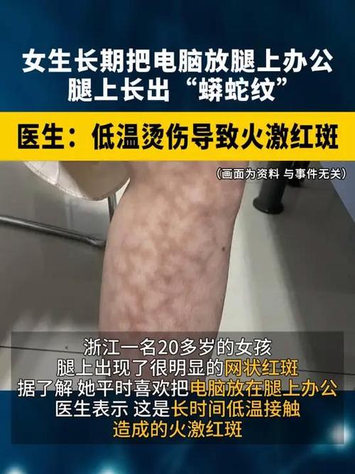 女生腿上长出蟒蛇纹,绝对策略计划研究_社交版40.12.0